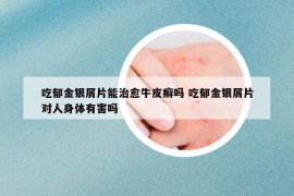 吃郁金銀屑片能治愈牛皮癬嗎 吃郁金銀屑片對(duì)人身體有害嗎