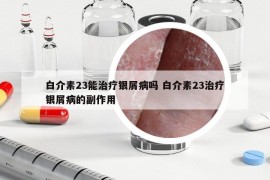 白介素23能治療銀屑病嗎 白介素23治療銀屑病的副作用
