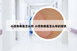 小孩有癬是怎么樣 小孩有癬是怎么樣的癥狀