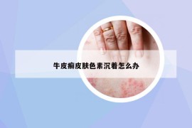 牛皮癬皮膚色素沉著怎么辦
