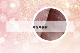 海報(bào)牛皮癬