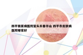 四平銀屑病醫(yī)院鰲頭長(zhǎng)春華山 四平市皮膚病醫(yī)院哪家好