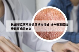 杭州哪家醫(yī)院治銀屑病治得好 杭州哪家醫(yī)院看銀屑病最有名