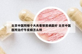 北京中醫(yī)院哪個(gè)大夫看銀屑病最好 北京中醫(yī)醫(yī)院治療牛皮癬怎么樣