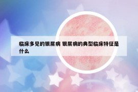 臨床多見的銀屑病 銀屑病的典型臨床特征是什么