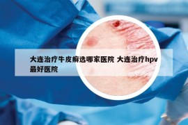 大連治療牛皮癬選哪家醫(yī)院 大連治療hpv最好醫(yī)院