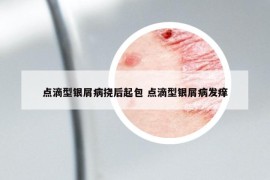 點滴型銀屑病撓后起包 點滴型銀屑病發(fā)癢