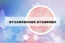 南寧治白癜風(fēng)最好的醫(yī)院 南寧治癲瘋病醫(yī)院