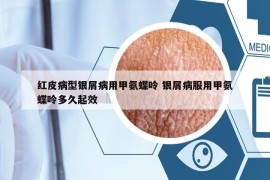 紅皮病型銀屑病用甲氨蝶呤 銀屑病服用甲氨蝶呤多久起效