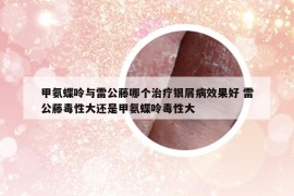 甲氨蝶呤與雷公藤哪個治療銀屑病效果好 雷公藤毒性大還是甲氨蝶呤毒性大