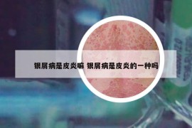 銀屑病是皮炎嘛 銀屑病是皮炎的一種嗎