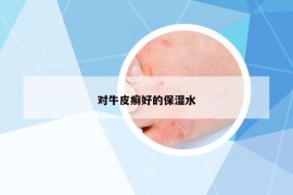 對(duì)牛皮癬好的保濕水