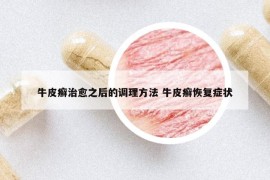 牛皮癬治愈之后的調(diào)理方法 牛皮癬恢復(fù)癥狀