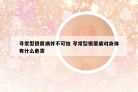 尋常型銀屑病并不可怕 尋常型銀屑病對身體有什么危害