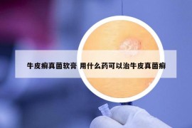 牛皮癬真菌軟膏 用什么藥可以治牛皮真菌癬