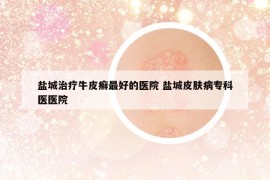 鹽城治療牛皮癬最好的醫(yī)院 鹽城皮膚病專科醫(yī)醫(yī)院