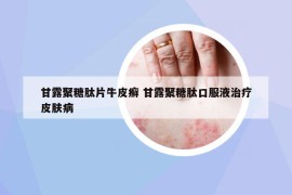 甘露聚糖肽片牛皮癬 甘露聚糖肽口服液治療皮膚病