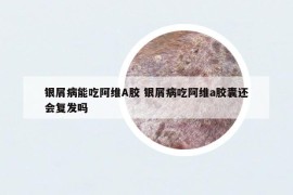 銀屑病能吃阿維A膠 銀屑病吃阿維a膠囊還會(huì)復(fù)發(fā)嗎