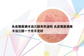 頭皮銀屑病卡泊三醇天天涂嗎 頭皮銀屑病用卡泊三醇一個月不見好