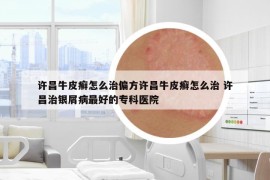 許昌牛皮癬怎么治偏方許昌牛皮癬怎么治 許昌治銀屑病最好的?？漆t(yī)院