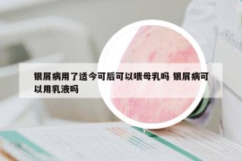 銀屑病用了適今可后可以喂母乳嗎 銀屑病可以用乳液嗎
