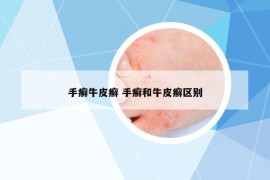 手癬牛皮癬 手癬和牛皮癬區(qū)別
