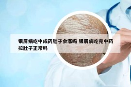 銀屑病吃中成藥肚子會(huì)漲嗎 銀屑病吃完中藥拉肚子正常嗎