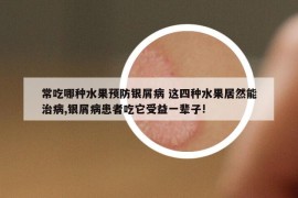 常吃哪種水果預防銀屑病 這四種水果居然能治病,銀屑病患者吃它受益一輩子!