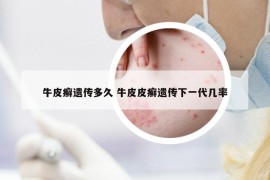 牛皮癬遺傳多久 牛皮皮癬遺傳下一代幾率