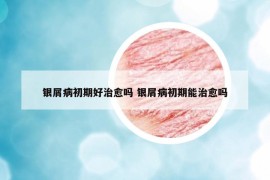 銀屑病初期好治愈嗎 銀屑病初期能治愈嗎