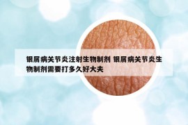 銀屑病關(guān)節(jié)炎注射生物制劑 銀屑病關(guān)節(jié)炎生物制劑需要打多久好大夫
