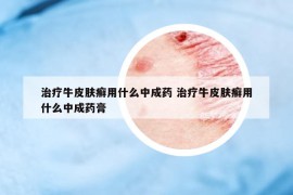 治療牛皮膚癬用什么中成藥 治療牛皮膚癬用什么中成藥膏