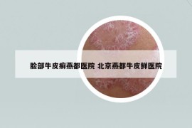 臉部牛皮癬燕都醫(yī)院 北京燕都牛皮鮮醫(yī)院