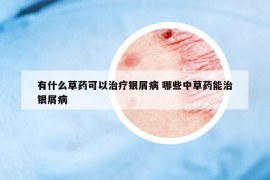 有什么草藥可以治療銀屑病 哪些中草藥能治銀屑病