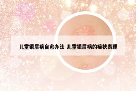 兒童銀屑病自愈辦法 兒童銀屑病的癥狀表現(xiàn)