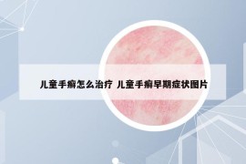 兒童手癬怎么治療 兒童手癬早期癥狀圖片