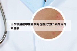 山東銀屑病哪里看的好醫(yī)院比較好 山東治療銀屑病