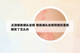 點滴銀屑病頭皮癢 銀屑病頭皮癢得很厲害抓破皮了怎么辦