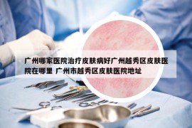 廣州哪家醫(yī)院治療皮膚病好廣州越秀區(qū)皮膚醫(yī)院在哪里 廣州市越秀區(qū)皮膚醫(yī)院地址