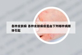 各種皮膚癬 各種皮膚癬癥是由下列哪種病原體引起