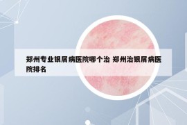 鄭州專業(yè)銀屑病醫(yī)院哪個治 鄭州治銀屑病醫(yī)院排名