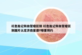 紅色胎記和血管瘤區(qū)別 紅色胎記和血管瘤區(qū)別圖片認(rèn)定濟南童康Y哪里預(yù)約