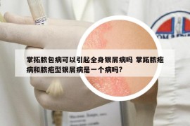 掌拓膿包病可以引起全身銀屑病嗎 掌跖膿皰病和膿皰型銀屑病是一個(gè)病嗎?