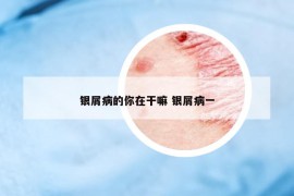 銀屑病的你在干嘛 銀屑病一