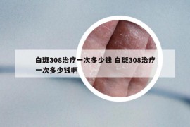 白斑308治療一次多少錢 白斑308治療一次多少錢啊