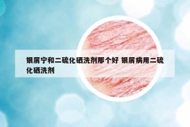 銀屑寧和二硫化硒洗劑那個(gè)好 銀屑病用二硫化硒洗劑