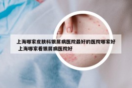 上海哪家皮膚科銀屑病醫(yī)院最好的醫(yī)院哪家好 上海哪家看銀屑病醫(yī)院好
