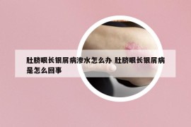 肚臍眼長(zhǎng)銀屑病滲水怎么辦 肚臍眼長(zhǎng)銀屑病是怎么回事