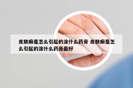 皮膚癬是怎么引起的涂什么藥膏 皮膚癬是怎么引起的涂什么藥膏最好