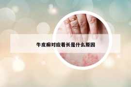牛皮癬對(duì)應(yīng)著長(zhǎng)是什么原因